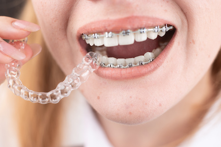 Invisalign Near Me Lake Oswego OR