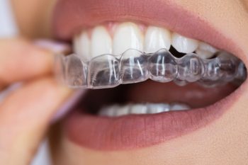 Clear Aligner Dental Night Guard