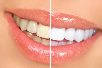 Woman Teeth