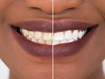 Teeth Whitening Near Me Tigard Or