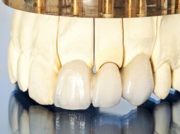 Dental Implants Lake Oswego Or
