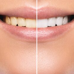 Teeth Whitening Portland OR Teeth Whitening Portland OR
