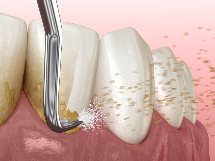 Dental Cleaning Near Me