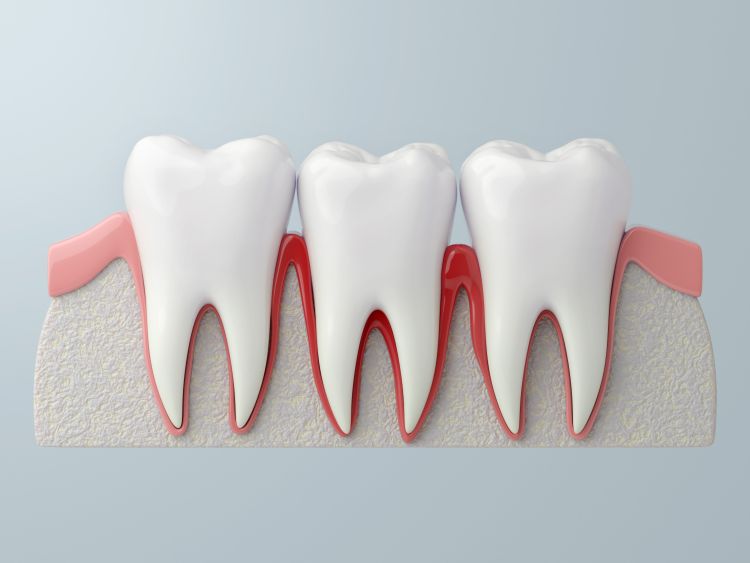 Gingivitis And Periodontitis