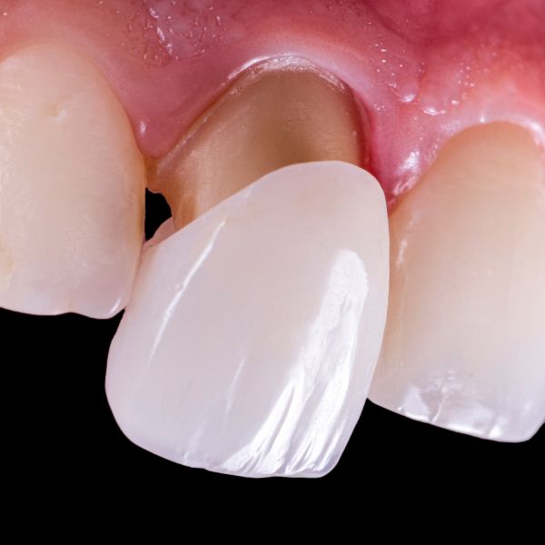 Cosmetic Dentist Near Me West Linn Or